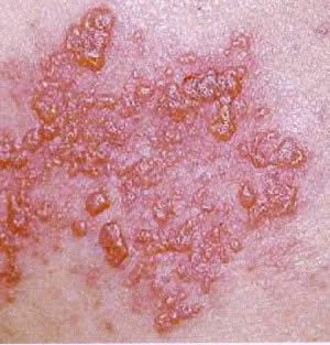 Herpes zoster shingles