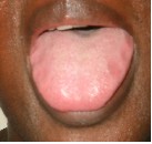 Figure 1 : This patient's tongue is very pale confirming her diagnosis of coldness (or yang deficiency) and some Blood deficiency.  Note the swelling of her tongue with toothmarks Ã¢â‚¬â€œ see 'shape' below
