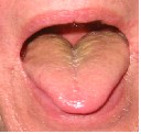 Figure 4: This patient's tongue has a fairly thick yellow coating at the back indicating some dampness and heat in his lower body