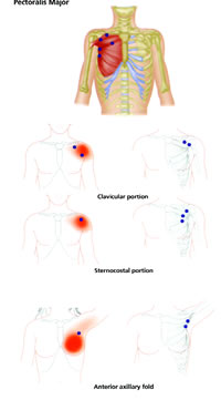 Figure 2: Pectoralis major Ã¢â‚¬â€œ Trigger Points and Referred Pain Patterns.