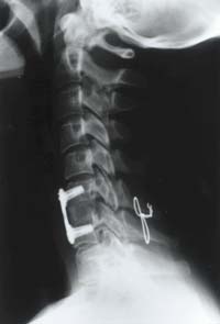 X-ray taken on 8th September 1998 – it shows the titanium plate, fusion and wiring of my vertebrae. This is a permanent structure