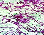 Candida albicans shown atta- ched to the villi on the gut wall