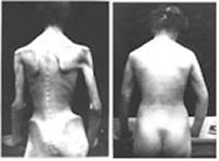 This picture shows the before and after results of a 20 year-old girl suffering with dyspepsia, chronic enterocolitis and terminal cachexia.