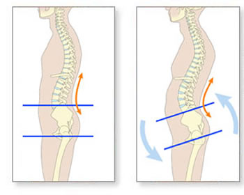 Lordosis