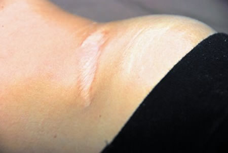 Scars are areas of fibrous tissue that have replaced normal skin, or other tissue, after injury.