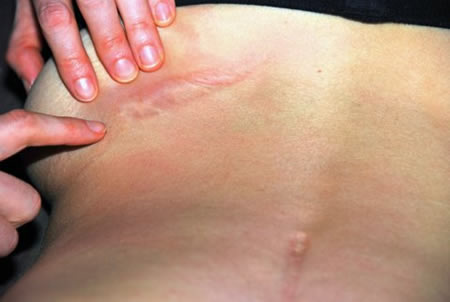 Adhesions are bands of scar tissue that anchor and support the wound.