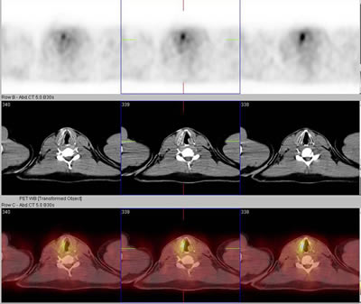 SPECT will demonstrate that there is a lack of perfusion (blood flow. Courtesy of http://neurotalk.psychcentral.com/thread10355-2.html)