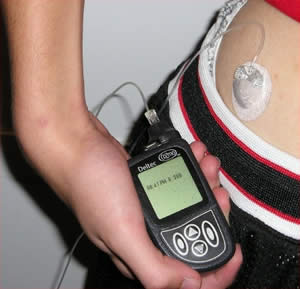 Insulin_pump_with_infusion_set