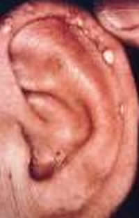 Ear tophi