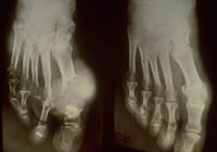 X-rays showing joint destruction and tophus formulation over time