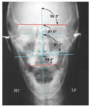 Figure 6. DORA Dental orthogonal radiographic analysis visualizing a cranial imbalance