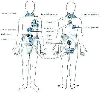 Areas of referred pain