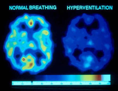 Diagram 1. Effects of overbreathing on Cerebral O2.1 Reduction of O2 Availability by 40 percent (Red = most O2, dark blue = least O2). In this image, oxygen availability in the brain is reduced by 40 percent as a result of about a minute of overbreathing (hyperventilation). Not only is oxygen availability reduced, but glucose critical to brain functioning is also markedly reduced as a result of cerebral vasoconstriction.