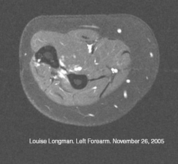 MRI scans: After PDT treatment