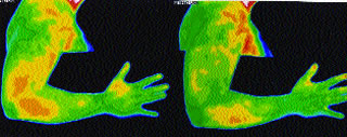 AThermal Imaging. Severe foot and elbow pain using thermographic imaging, with pain denoted by the red colour in the Ã¢â‚¬ËœbeforeÃ¢â‚¬â„¢ photo of the left leg and right elbow.