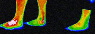 AThermal Imaging. Severe foot and elbow pain using thermographic imaging, with pain denoted by the red colour in the Ã¢â‚¬ËœbeforeÃ¢â‚¬â„¢ photo of the left leg and right elbow.