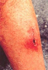 Photo 1 - Leg Injury