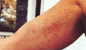 Photo 2 - Contact Dermatitis