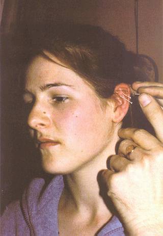 Auricular Acupuncture: Points in the ear which relate to the internal organs and induce positive mood changes.