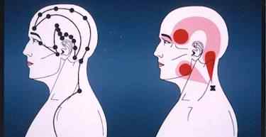 A diagram illustrating the similarity between the path of the Gall Bladder meridian (left) and the radiation of pain from a trigger point (the cross) in the trapezius muscle.