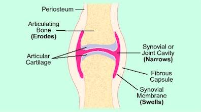 Fig 1, The cumulative effects of decades of use and mis-use leads to degenerative changes in joints. This damage is further compounded by a decreased ability by the body to repair joint structures, much of which can be attributed to poor nutritional status.