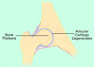 Fig 2. The cumulative effects of decades of use and mis-use leads to degenerative changes in joints. This damage is further compounded by a decreased ability by the body to repair joint structures, much of which can be attributed to poor nutritional status.