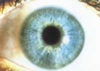 A Lymphatic Iris