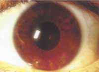 A Haematogenic Iris