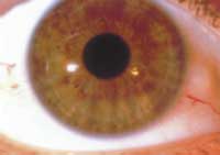 A Biliary (mixed) Iris