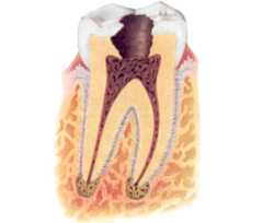Photo 2 Toxins from pulp bacteria cause inflammation in the bone
