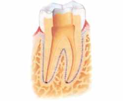 Photo 4 The canals are now prepared (shaped) to receive the root canal filling
