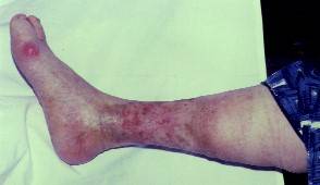 Chronic leg ulceration after 4 months of daily application of VIP light therapy combined with normal wound management