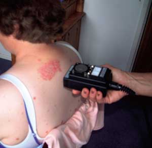 Fig 7. Infra-red scanning of psoriasis can reveal biological activity of +5.0deg C higher than unaffected skin.