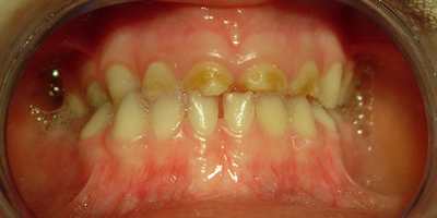 Figure 2a. This shows a four year old child with rampant tooth decay and erosion before cosmetic treatment.