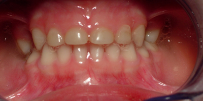 Figure 2b. This shows the same child as seen if Figure 2a following cosmetic treatment using bonded composite material to obtain a functional aesthetic dental appearance Figure 2b. This shows the same child as seen if Figure 2a following cosmetic treatment using bonded composite material to obtain a functional aesthetic dental appearance
