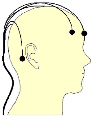 The five electrodes are self adhesive and located on the head as shown in Figure 5.