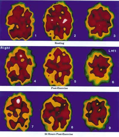 The Negative Effects of Exercise on an ME/CFS Dysfunctional Brain