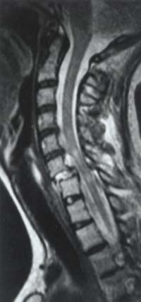 MRI Scan taken after manipulation, weights and clamping into halo (removed for scan) at Southampton MRI scanner on 30th June 1998. It clearly shows the injury, misalignment, compression and trauma onto the spinal cord. This apparently is severe and indicated possible tetraplegia