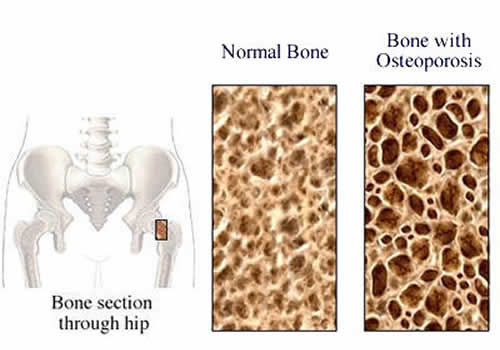 Osteoporosis