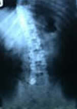 Damien's xray