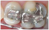 Typical mercury amalgam 'silver' dental fillings