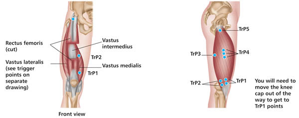 Trigger Point Chart Online