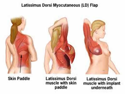 Latissimus Dorsi