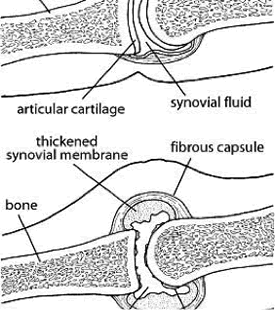 Inflammation