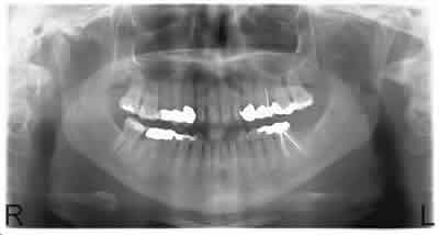 OPG radiograph patient A