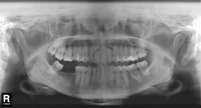 OPG radiograph patient B