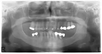 COPG radiograph patient C