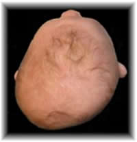 Plagiocephalic Head Shape