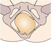 Posterior Birth