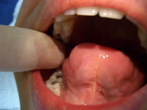 Inhibition to the base of the maxillary sinus